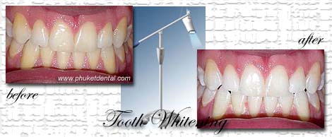 Tooth Whitening:Coldlight,non-LASER,LED,Natural Plus at Phuket Dental Clinic,Thailand